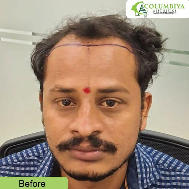 Columbiya Aesthetics Results- Best Hair Transplant Clinic Viman Nagar
