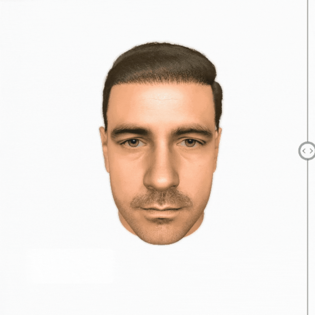 AI Hair Transplant Visualization