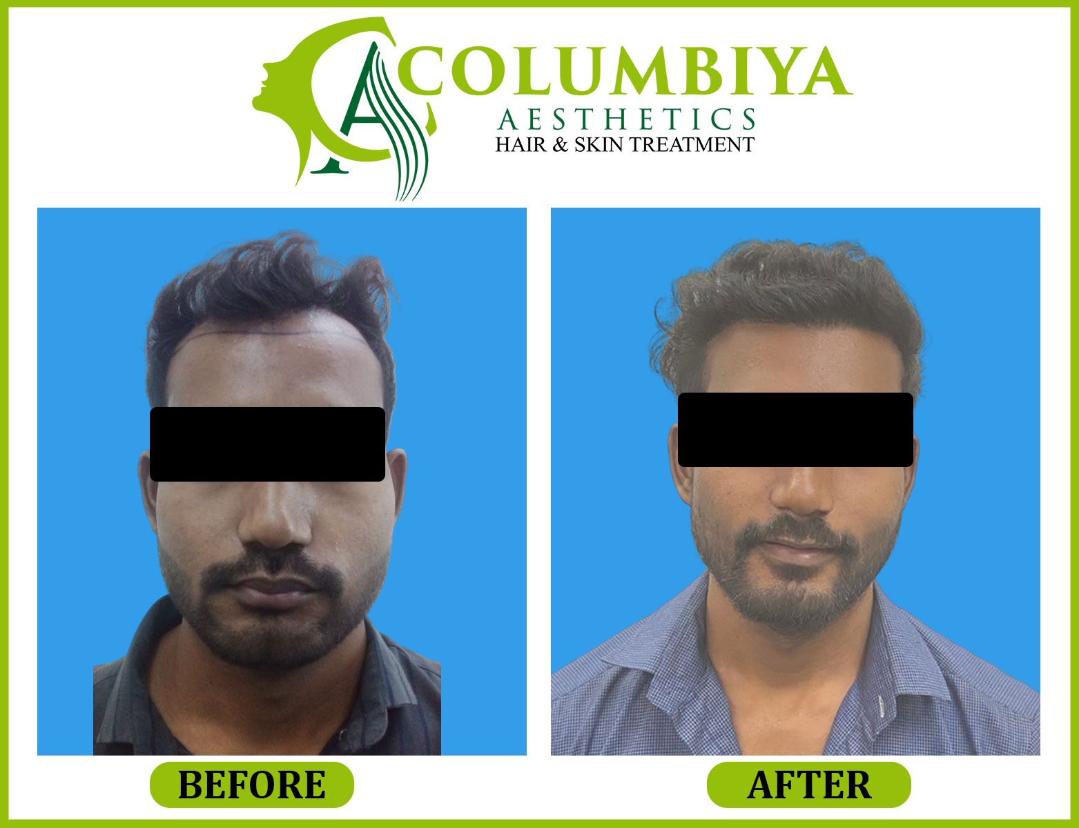 Scalp Result