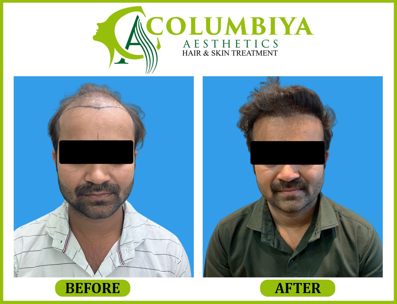 Scalp Result